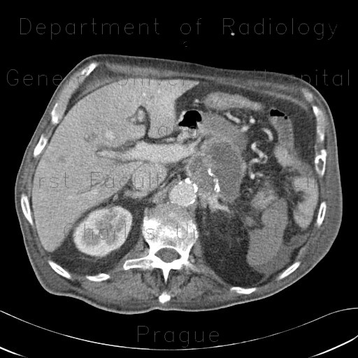 Radiology image - Recurrence of renal cell carcinoma, hypervascular metastases in liver and retroperitoneum: Abdomen, Kidney and adrenals, Liver: CT - Computed tomography