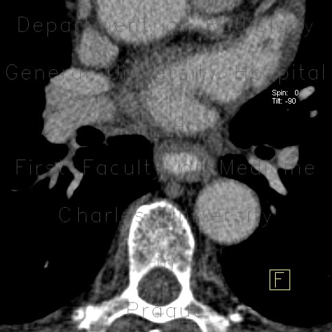 Reflux esophagitis on CT