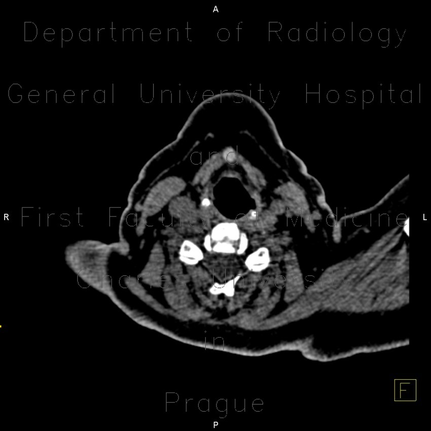 Remnant of thyreoglossal duct