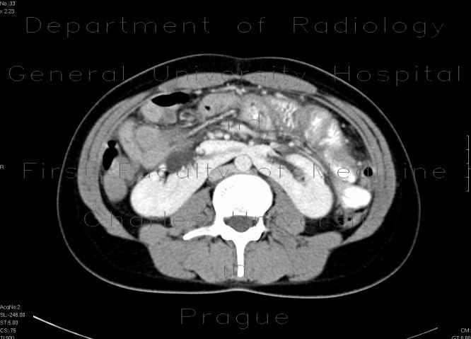 Radiology image - Ren arcuatus: Abdomen, Kidney and adrenals: CT - Computed tomography
