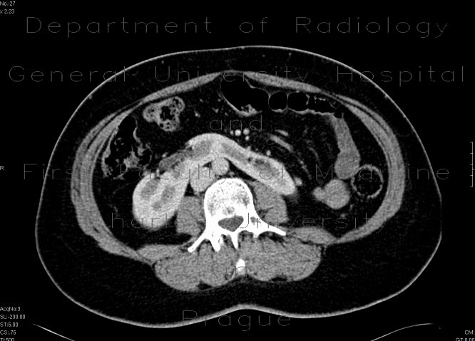 Radiology image - Ren arcuatus, horseshoe kidney: Abdomen, Kidney and adrenals: CT - Computed tomography