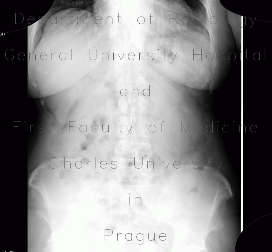 Radiology image - Renal carcinoma, Grawitz tumour: Abdomen, Kidney and adrenals: X-ray - Plain radiograph