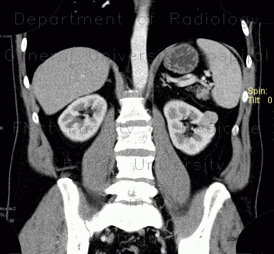 Renal carcinoma, small, detected on ultrasound, correlation of ultrasound and CT