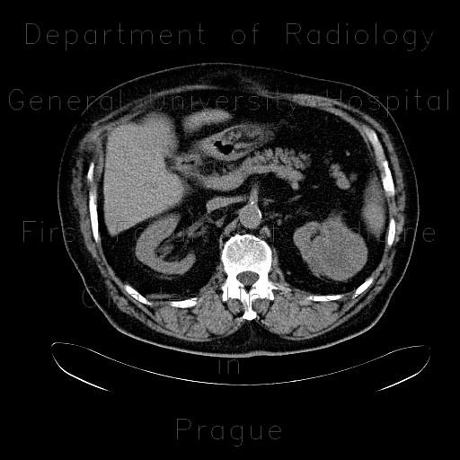 Renal carcinoma, treatment with RFA, follow-up