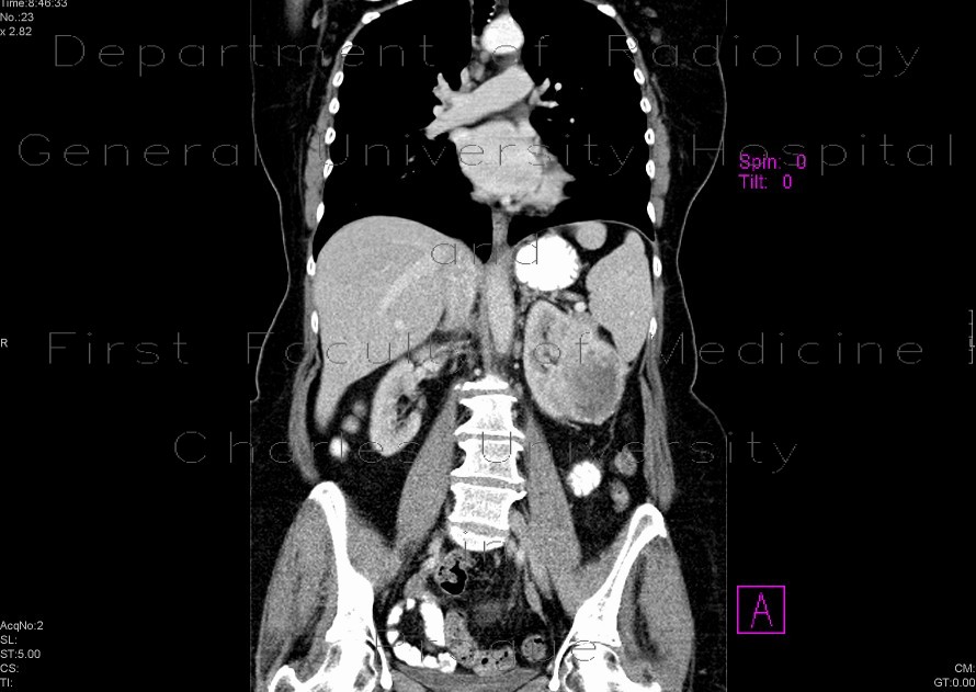 Renal cell carcinoma