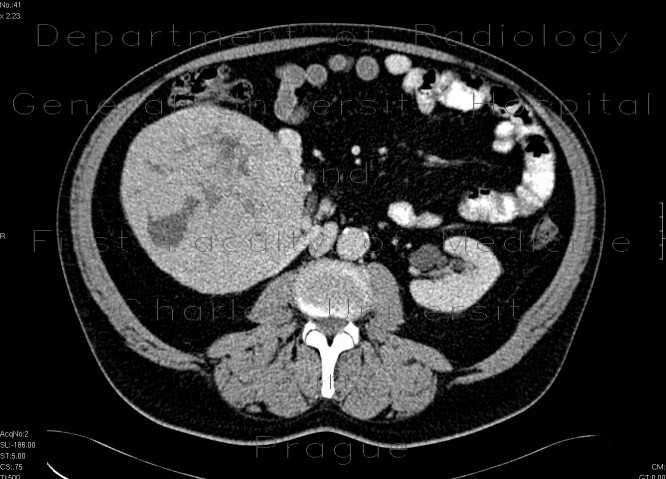 Renal cell carcinoma