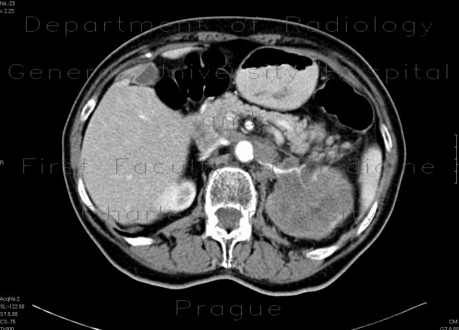 Radiology image - Renal cell carcinoma: Abdomen, Kidney and adrenals: CT - Computed tomography