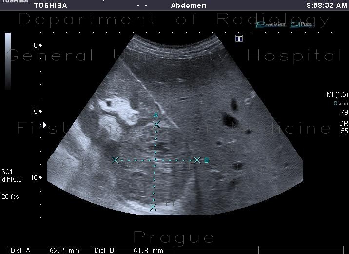 Radiology image - Renal cell carcinoma: Abdomen, Kidney and adrenals: US - Ultrasound