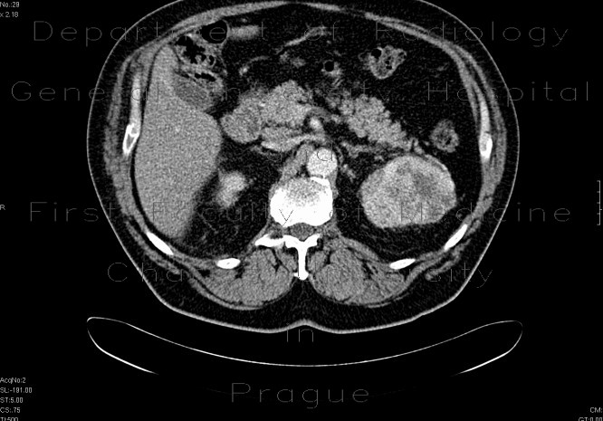 Radiology image - Renal cell carcinoma: Abdomen, Kidney and adrenals: CT - Computed tomography