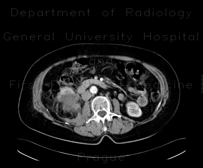 Radiology image - Renal cell carcinoma, RFA, embolization, follow-up: Abdomen, Kidney and adrenals: CT - Computed tomography