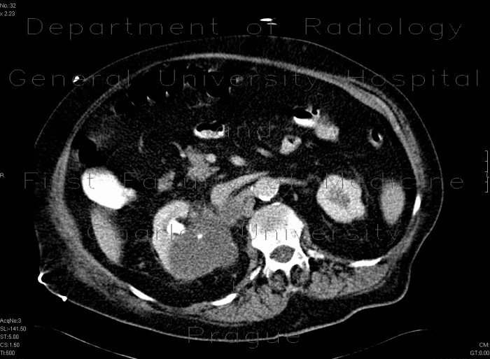 Radiology image - Renal cell carcinoma, atypical: Abdomen, Kidney and adrenals: CT - Computed tomography