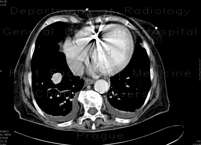 Radiology image - Renal cell carcinoma, recurrence, metastases: Abdomen, Thorax, Kidney and adrenals, Liver, Lung, Lymphatic: CT - Computed tomography