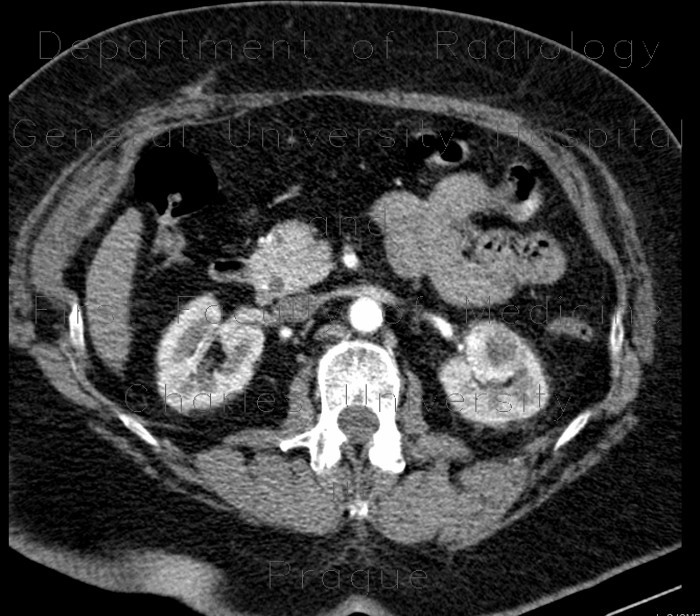 Renal cell carcinoma, small