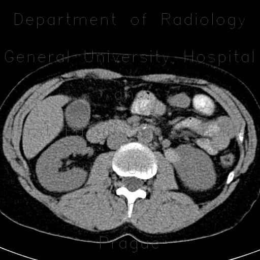Radiology image - Renal cyst, complicated cyst: Abdomen, Kidney and adrenals: CT - Computed tomography