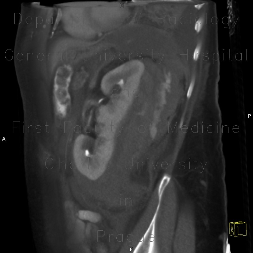 Renal hemorrhage, staghorn calculus