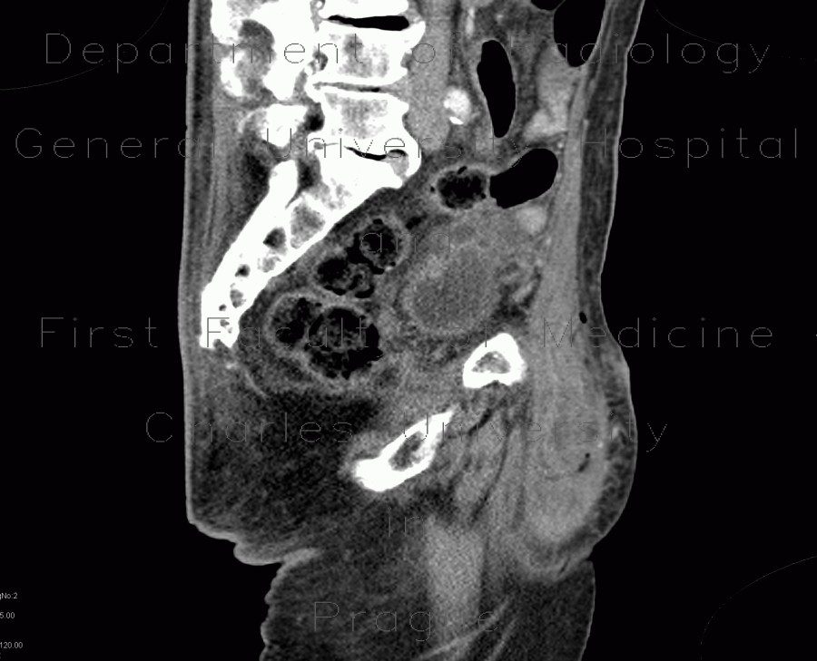 Radiology image - Repair of inguinal hernia, hematoma, mimic of recurrence: Abdomen, Peritoneal cavity: CT - Computed tomography