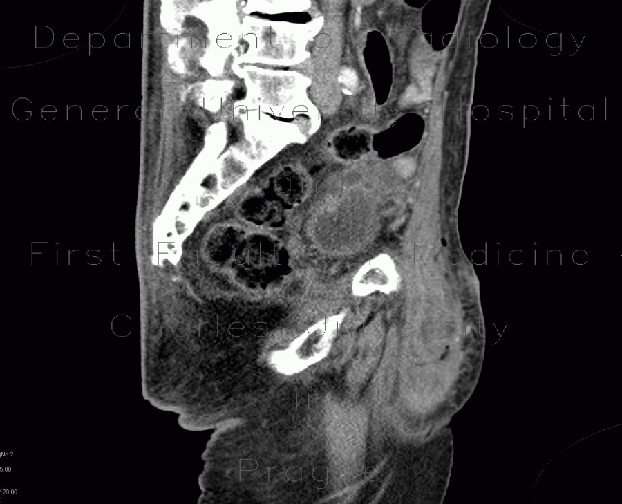 Repair of inguinal hernia, hematoma, mimic of recurrence