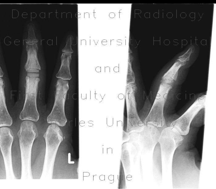 Replacement of interphalangeal joint