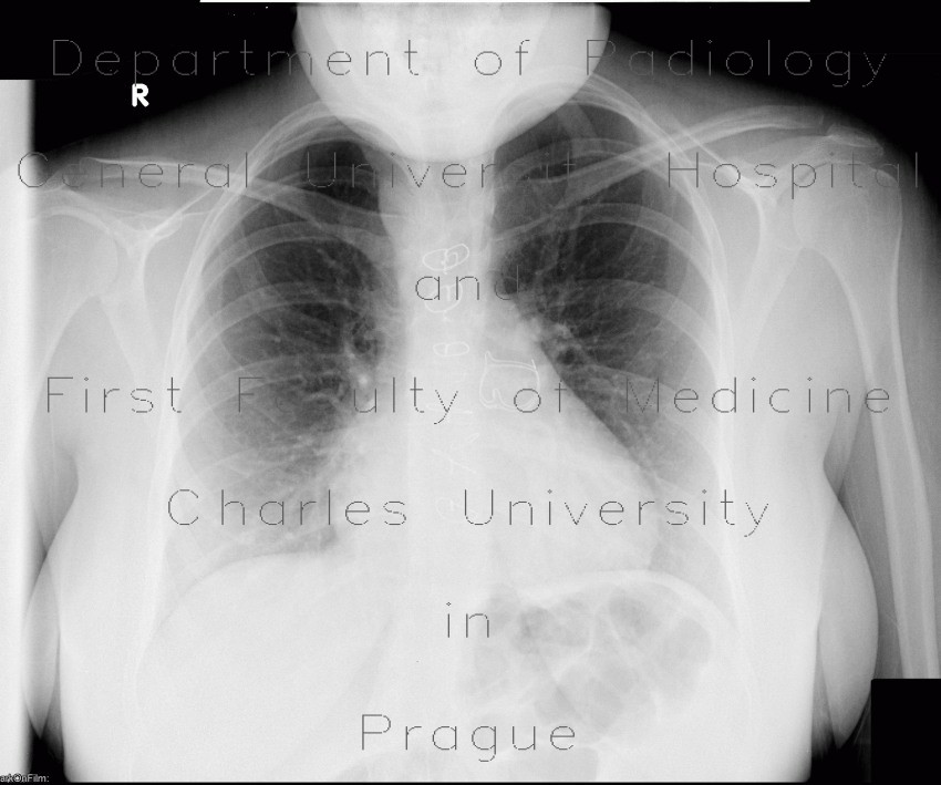 Replacement of pulmonary valve, Fallot's tetralogy