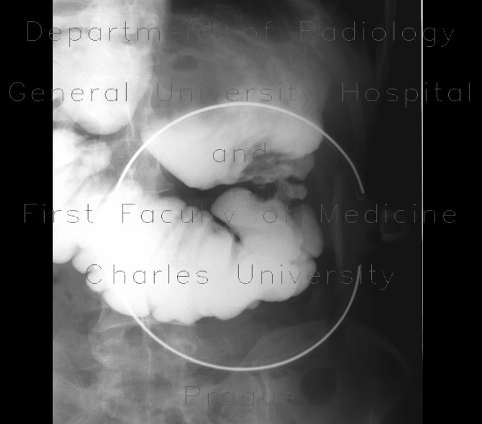 Radiology image - Resection of oesophagus, colon interponat, anastomosis: Abdomen, Thorax, Oesophagus, Stomach: RF - Fluoroscopy