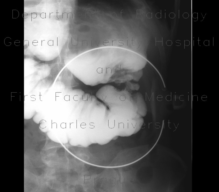 Resection of oesophagus, colon interponat, anastomosis