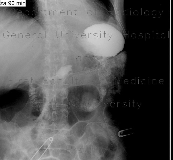 Radiology image - Resection of stomach, Billroth I: Abdomen, Stomach: RF - Fluoroscopy