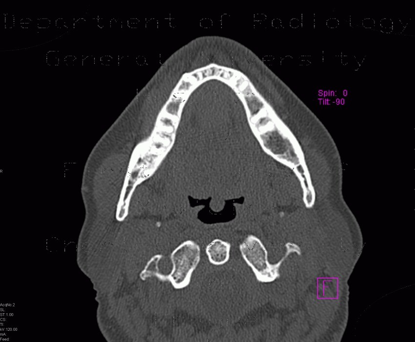 Radiology image - Residual cavity in mandible after extraction of tooth: Head and Neck, Bone, Oral cavity: CT - Computed tomography