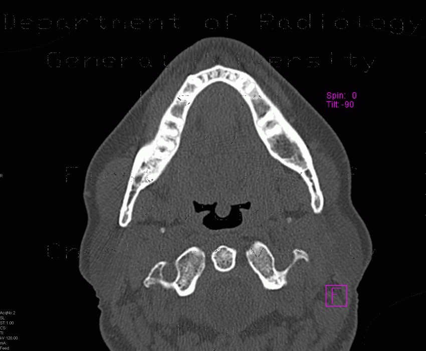 Residual cavity in mandible after extraction of tooth