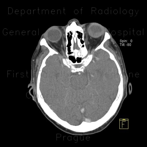 Radiology image - Retinal detachment, tumour of eyeball: Head and Neck, Orbit: CT - Computed tomography