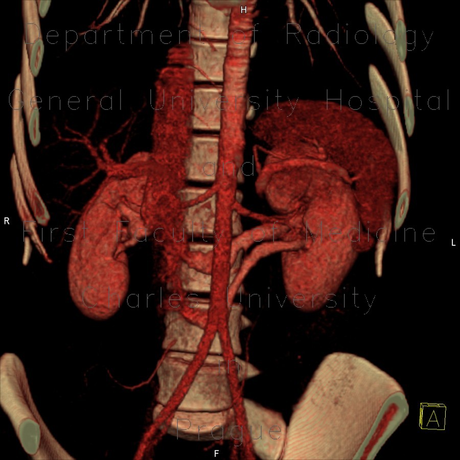 Radiology image - Retroaortic renal vein, duplication of renal vein, VRT: Abdomen, Kidney and adrenals, Vessels: CT - Computed tomography