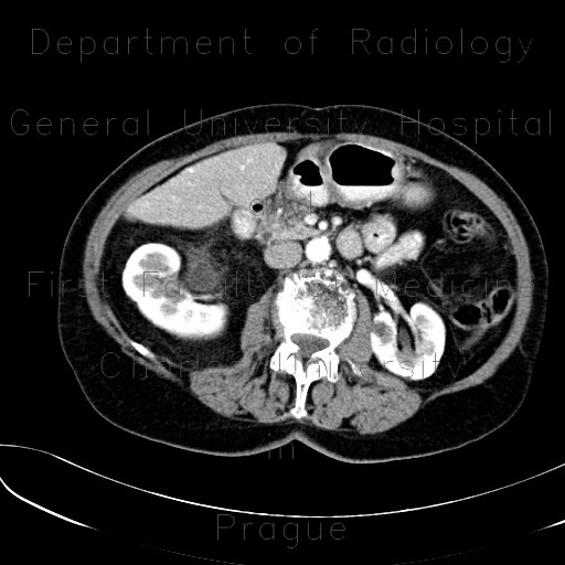 Retroperitoneal lipoma, large