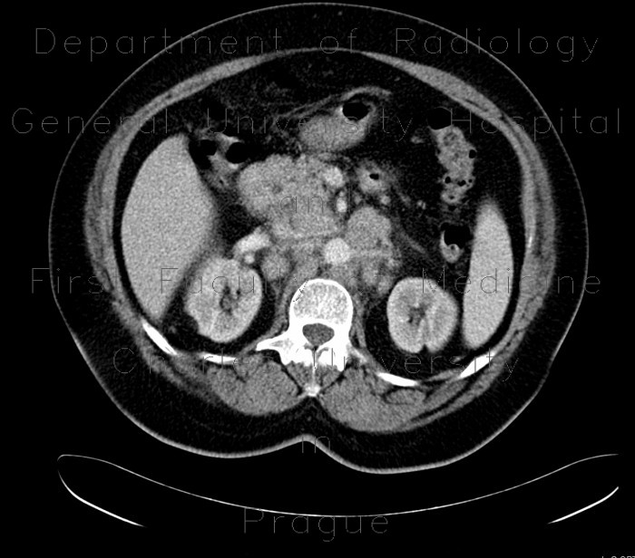 Radiology image - Retroperitoneal lymphadenopathy: Abdomen, Lymphatic, Retroperitoneum, pelvis: CT - Computed tomography