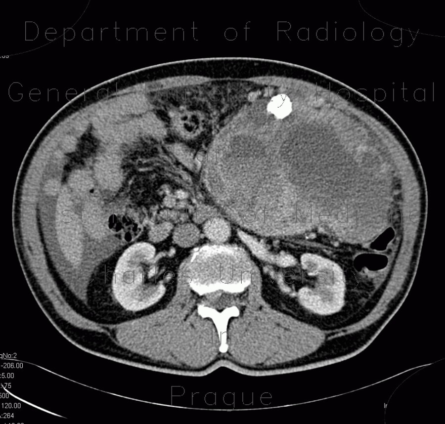 Radiology image - Retroperitoneal sarcoma, sarcoma of retroperitoneum, biopsy, CT guided biopsy: Abdomen, Retroperitoneum, pelvis: CT - Computed tomography