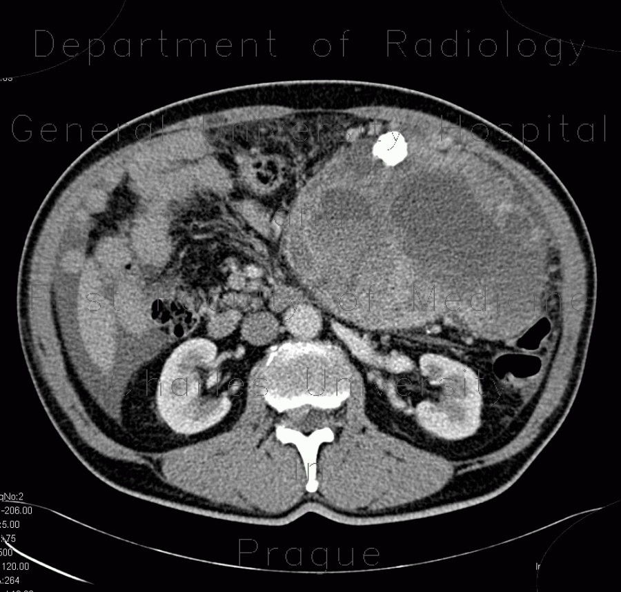 Retroperitoneal sarcoma, sarcoma of retroperitoneum, biopsy, CT guided biopsy