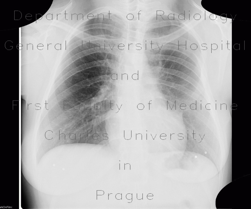 Rib anomally