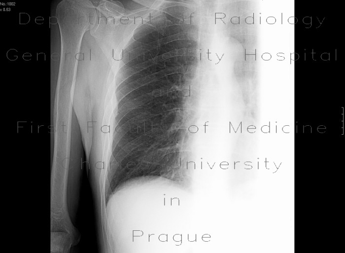Radiology image - Rib fracture: Thorax, Bone: X-ray - Plain radiograph