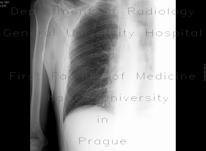 Rib fracture