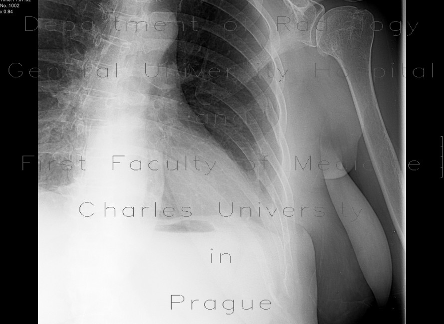 Rib fracture