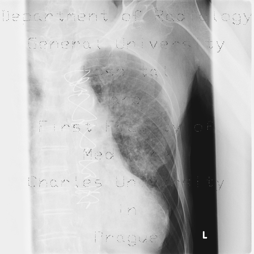 Rib fracture, lung contusion, hematoma, pneumothorax, hydropneumothorax