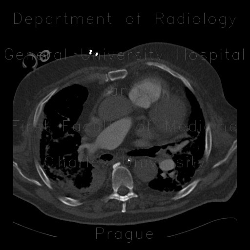 Radiology image - Rib fractures after resuscitation: Thorax, Bone: CT - Computed tomography