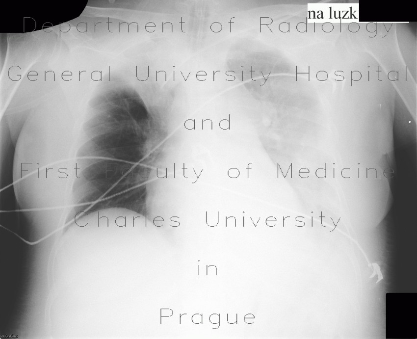 Right upper lobe atelectasis, pleural effusion on supine radiograph