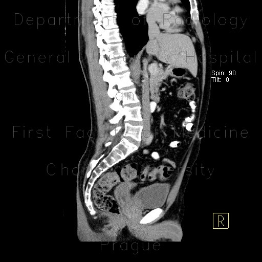 Radiology image - Rudimentary uterus: Abdomen, Gynecology, Urinary tract: CT - Computed tomography