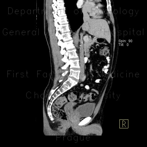 Rudimentary uterus