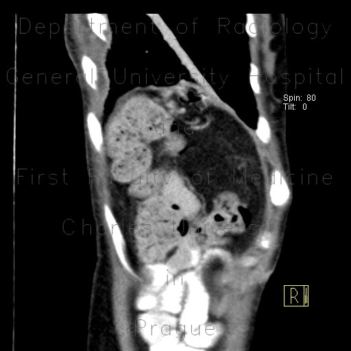 Rupture of the diaphragm, diaphragmatic hernia