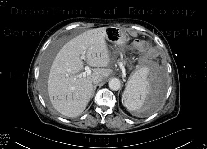 Radiology image - Rupture of the spleen: Abdomen, Lymphatic, Retroperitoneum, pelvis: CT - Computed tomography