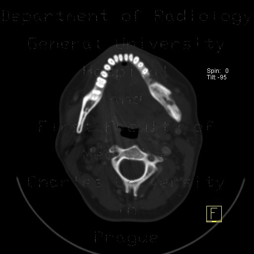 SAPHO syndrome