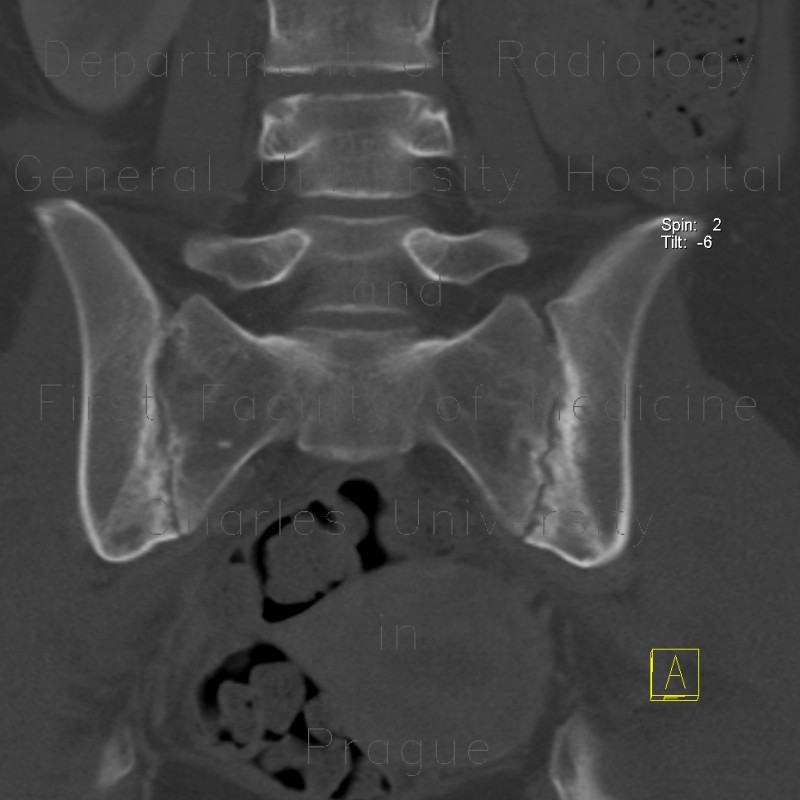 Sacroileitis