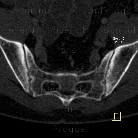 Radiology image - Sacroileitis, Crohn