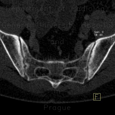 Sacroileitis, Crohn's disease