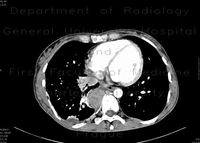 Sacroma of chest wall